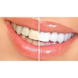 benzi-albire-dinti-dental-360-white-28-benzi-2.jpg