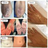 aparat-aparat-tratare-psoriasis-vitiligo-herpes-eczeme-dermatita-atopica-phototerapie-308nm-xeci-lampa-uvb-profesional-xca-2.jpg